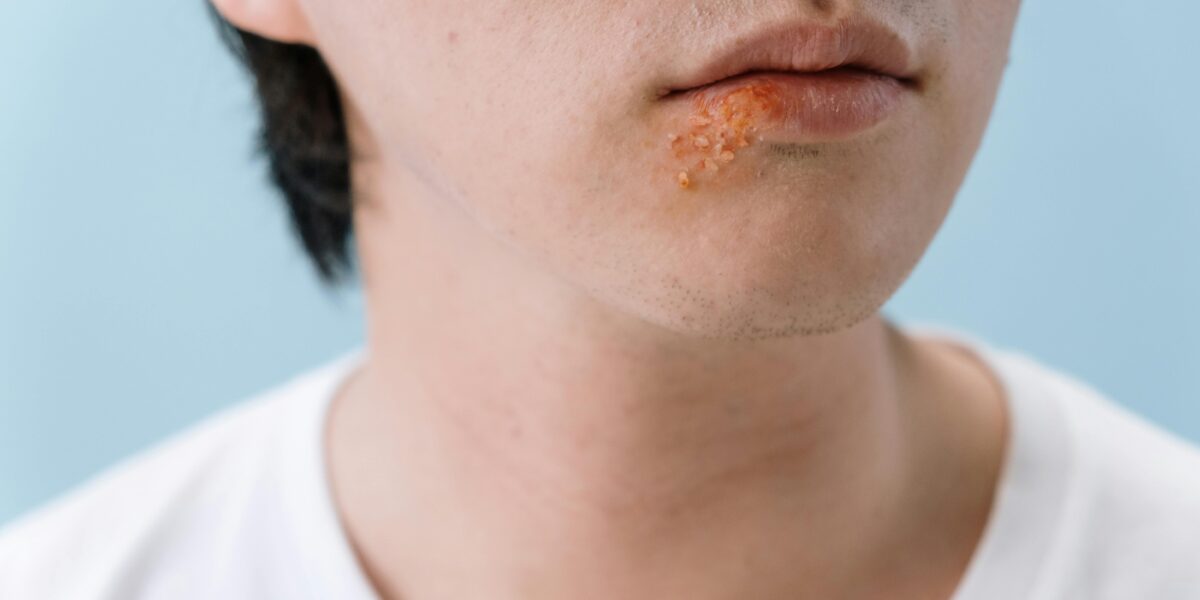 herpes