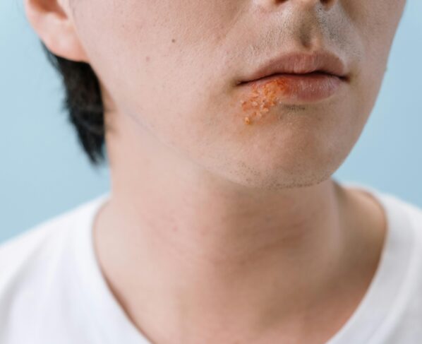 herpes