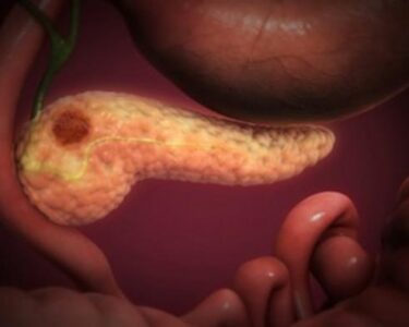 "Pancreatic Cancer" by Scientific Animations Inc. Image Source Link: https://openverse.org/image/d465039a-3408-42d2-beff-35b4959f0b8a?q=pancreatic+cancer&p=7