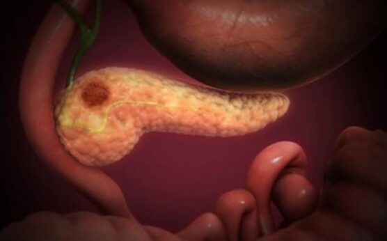 "Pancreatic Cancer" by Scientific Animations Inc. Image Source Link: https://openverse.org/image/d465039a-3408-42d2-beff-35b4959f0b8a?q=pancreatic+cancer&p=7