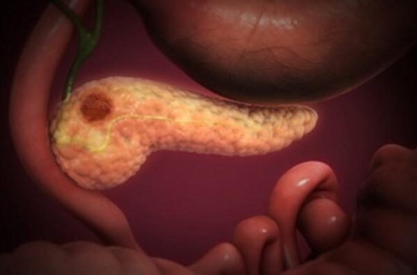 "Pancreatic Cancer" by Scientific Animations Inc. Image Source Link: https://openverse.org/image/d465039a-3408-42d2-beff-35b4959f0b8a?q=pancreatic+cancer&p=7