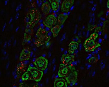 Washingtoni Ülikooli Meditsiinikooli teadlased on välja töötanud nina kaudu manustatava mitteinvasiivse ravimi, mis hävitas hiirtel surmava ajukasvaja. Ravim põhineb sfäärilisel nukleiinhappel ehk nanomaterjalil (punane), mis liigub nina kaudu mööda närviteid (roheline) ajju ning vallandab immuunvastuse, mis elimineerib kasvaja. Foto Washington University School of Medicine in St. Louis