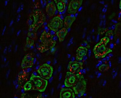 Washingtoni Ülikooli Meditsiinikooli teadlased on välja töötanud nina kaudu manustatava mitteinvasiivse ravimi, mis hävitas hiirtel surmava ajukasvaja. Ravim põhineb sfäärilisel nukleiinhappel ehk nanomaterjalil (punane), mis liigub nina kaudu mööda närviteid (roheline) ajju ning vallandab immuunvastuse, mis elimineerib kasvaja. Foto Washington University School of Medicine in St. Louis