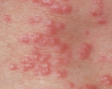 M2600127-Red_papules_on_the_skin_due_to_scabi.width-1534-1.jpg