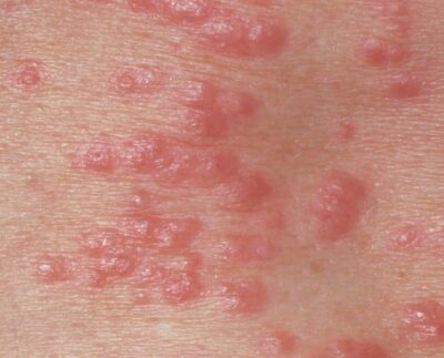 M2600127-Red_papules_on_the_skin_due_to_scabi.width-1534-1.jpg