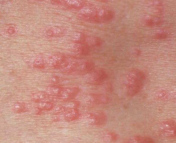 M2600127-Red_papules_on_the_skin_due_to_scabi.width-1534-1.jpg